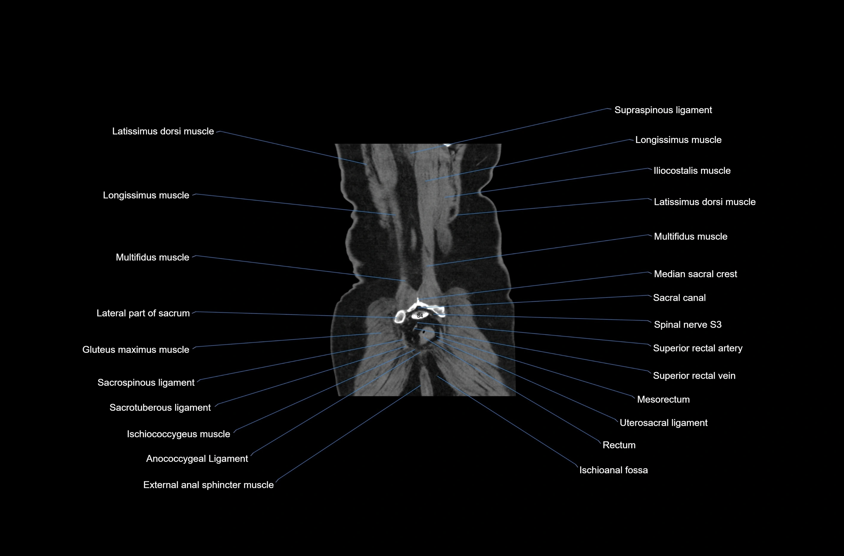 CT abdomen coronal cross sectional anatomy labelled radiology image-00078.webp